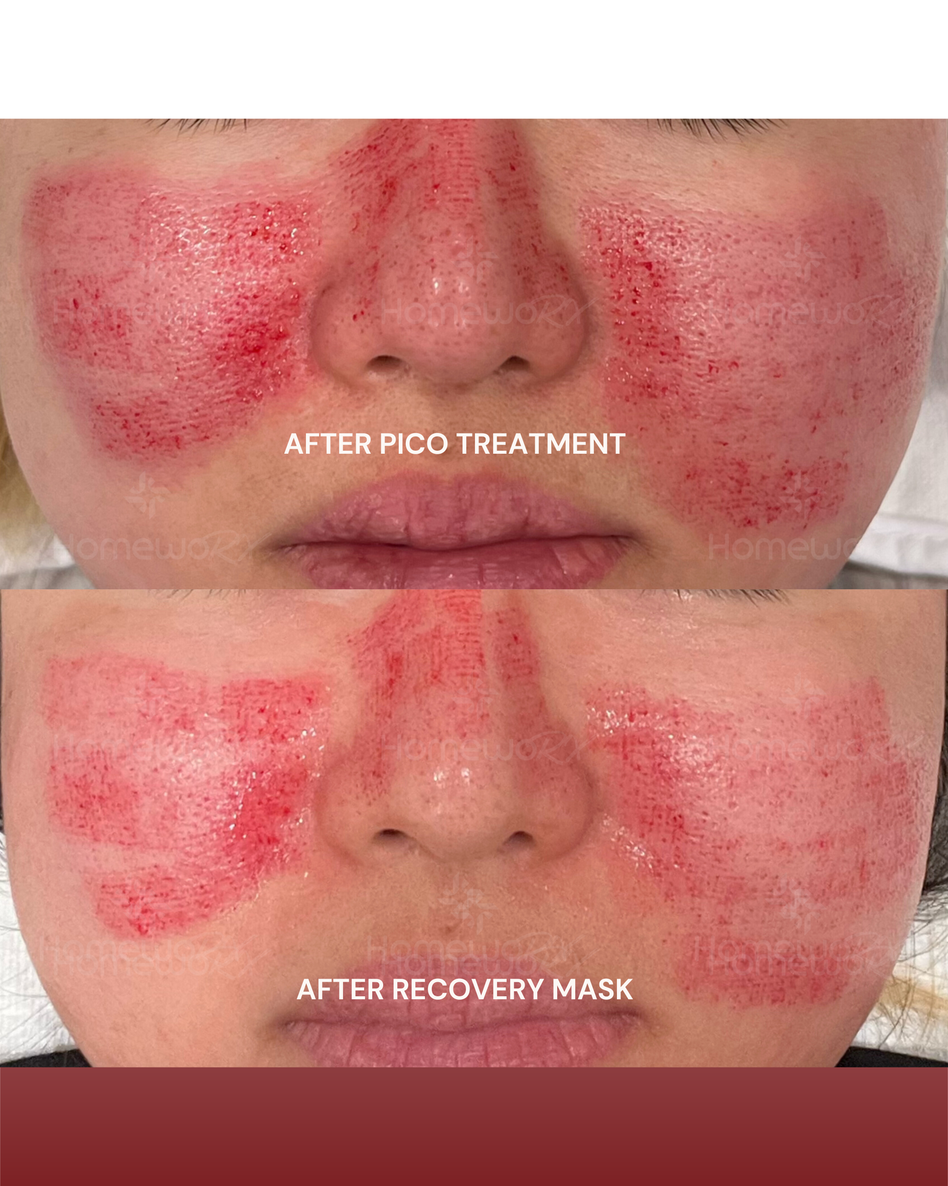 Before and after comparison of a facial treatment with visible redness on a person's face. PostDoc_Post-Laser Recovery
