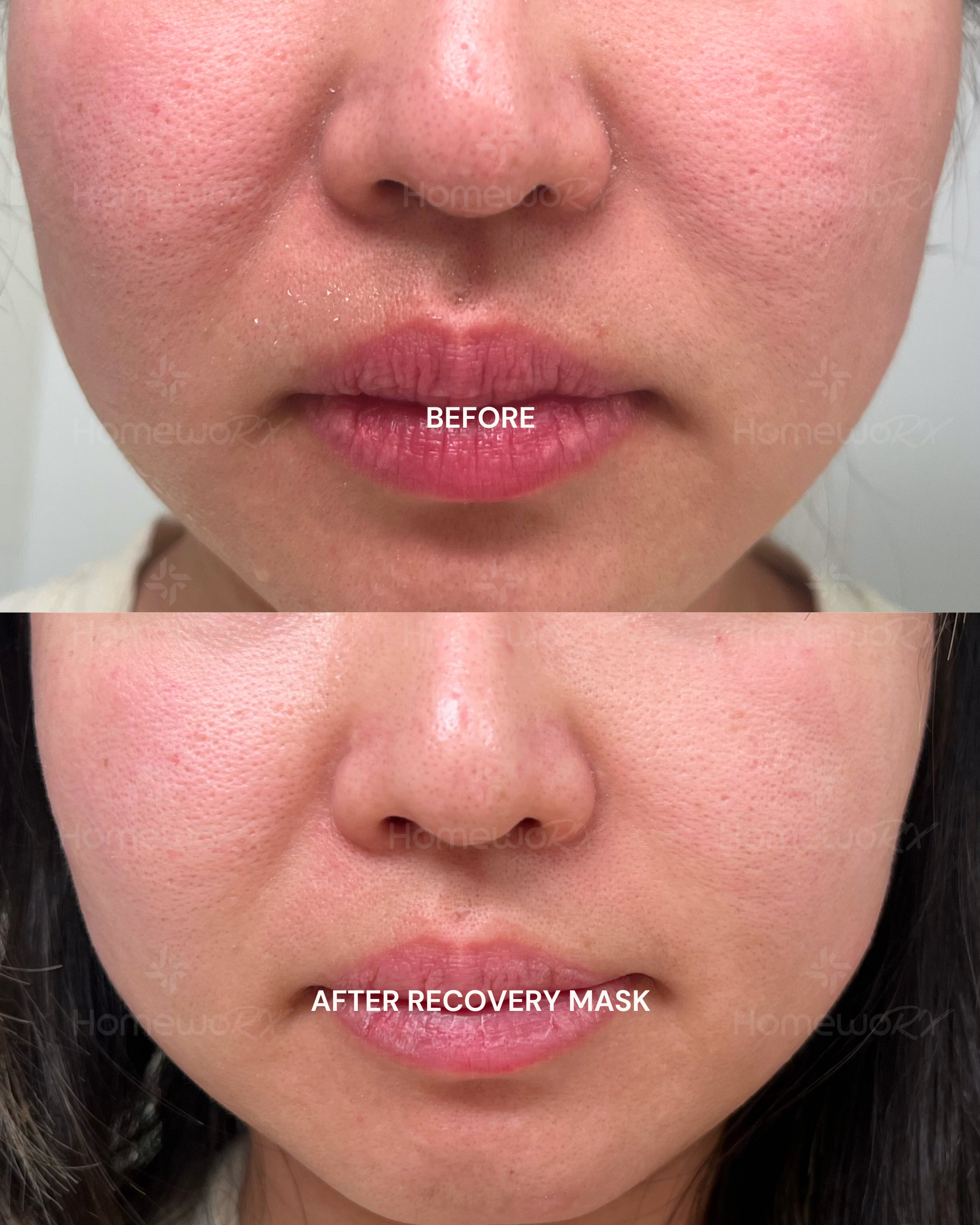 Before and after comparison of a person's face with a recovery mask, showing skin texture and color changes.